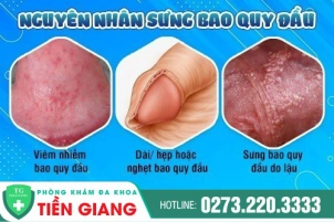 nguyen-nhan-gay-sung-bao-quy-dau-la-gi-kham-chua-tri-o-dau-339