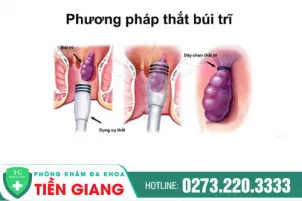 that-bui-tri-la-gi-nguyen-nhan-that-bui-tri-940