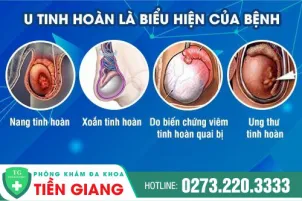 u-tinh-hoan-la-gi-cach-chua-tri-u-tinh-hoan-nam-gioi-107