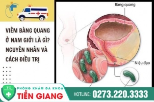 viem-bang-quang-la-gi-co-phuong-phap-chua-khoi-khong-256