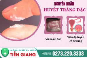 ra-huyet-trang-dac-la-benh-ly-phu-khoa-gi-nguyen-nhan-va-cach-dieu-tri-1231