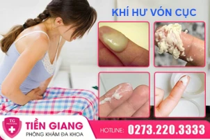 khi-hu-bi-von-cuc-la-hien-tuong-gi-nguyen-nhan-va-cach-tri-1420