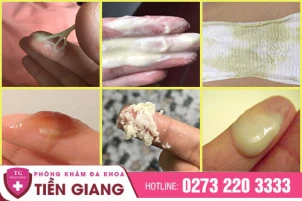 ra-dich-bat-thuong-o-vung-kin-va-nhung-dieu-can-biet-1415