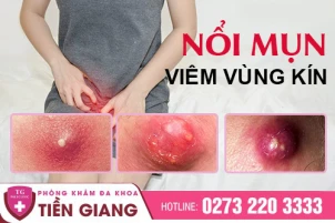 noi-mun-vung-kin-phai-lam-sao-day-266