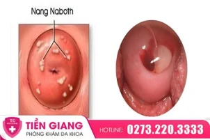 nang-naboth-co-tu-cung-la-gi-nguyen-nhan-dau-hieu-va-cach-dieu-tri-1466