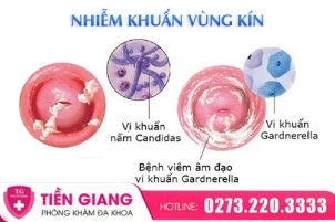 am-dao-bi-nhiem-khuan-do-dau-khac-phuc-the-nao-1404