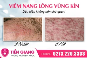 viem-nang-long-vung-kin-la-gi-nguyen-nhan-va-cach-xu-ly-an-toan-1433